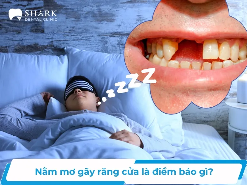 Giải Mã Bí Ẩn Giấc Mơ Gãy Răng Cửa: Điềm Báo Hay Lời Cảnh Tỉnh?